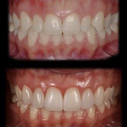 Faccette Dentali Estetiche | Dott.ssa Camilla Molinari