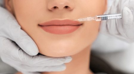 Filler Labbra | Dott.ssa Camilla Molinari